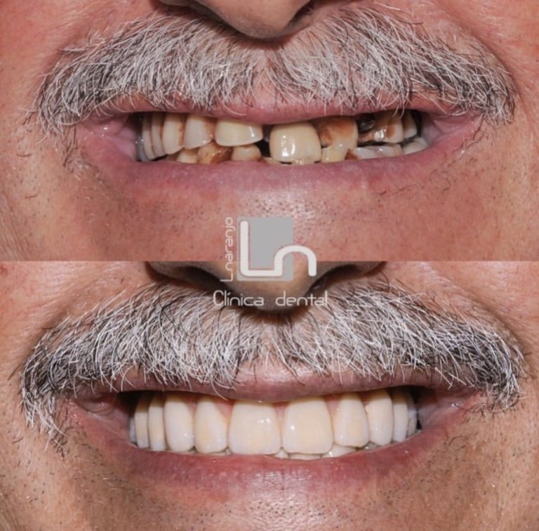 precio-implante-dental