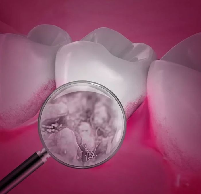 prevencion-enfermedad-periodontal