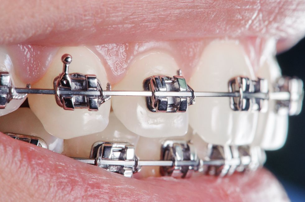 cera-dental-ortodoncia